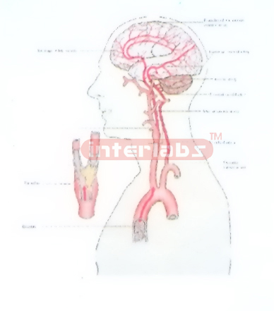 HANGING HUMAN THROMBUS PRODUCTION AND SITE PEMSTRATION IN BRAIN